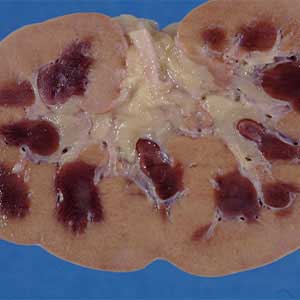 Acute Kidney Failure in vijayawada