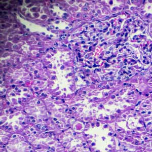 Kidney Biopsy in vijayawada